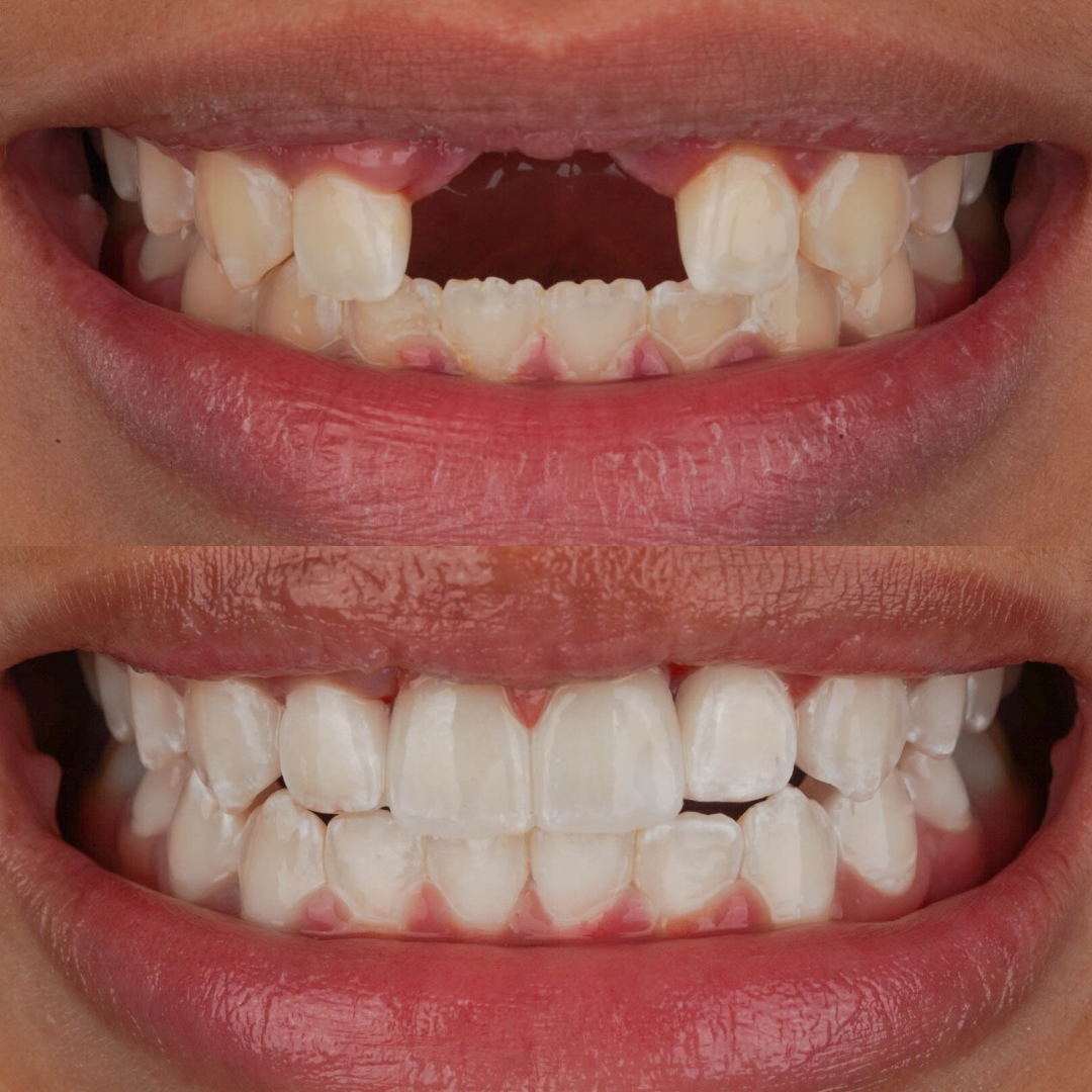 Before and after dental bridges restoring a complete smile